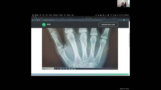 AI Diagnoses Fractures | AI Camp 2022