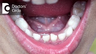 What Should One Do If Adult Permanent Tooth Is Coming Behind Milk Teeth? - Dr. Raju Srinivas