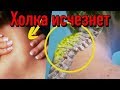 Как избавиться от Холки | Холка или вдовий горбик - самые эффективные способы борьбы