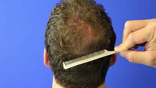 Hair Transplant Crown Area | Only 6 Months Post-Op!