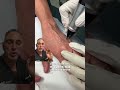 Laser Treatment of Brown Spots on Hands