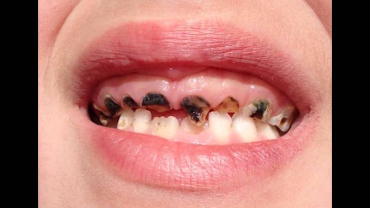 Resultado de imagen para caries rampante