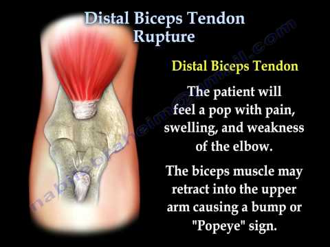 Distal Biceps Tendon Rupture - Everything You Need To Know - Dr. Nabil Ebraheim