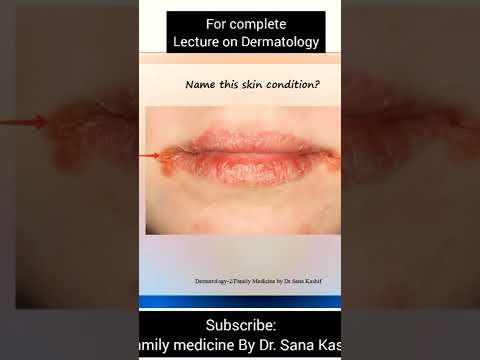 Video: Angular cheilitis itapona lini?