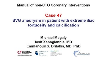 Case 47: PCI Manual - SVG aneurysm and iliac tortuosity