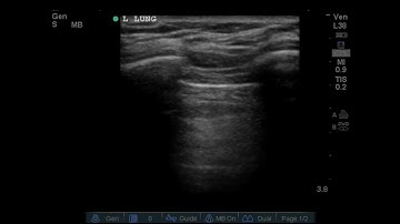 Lung ultrasound demonstrating the ABSENCE of lung sliding