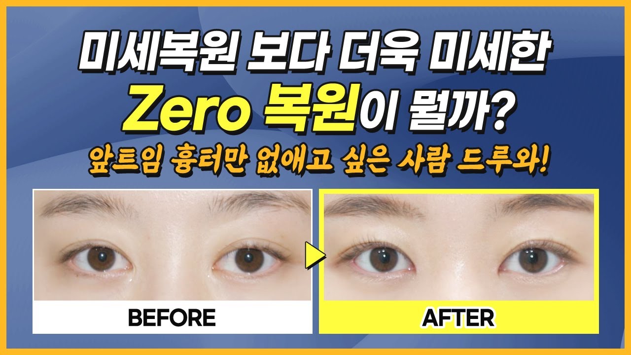 눈 크기는 작아지지 않고 앞트임흉터만 없앨 수 있는 제로복원은? | 메이트성형외과
