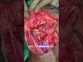 Level IA Neck Dissection | Short Video Education | Ep 08