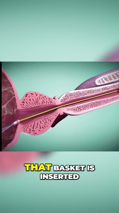 Prostate Treatment: Revolutionary ITIND Procedure