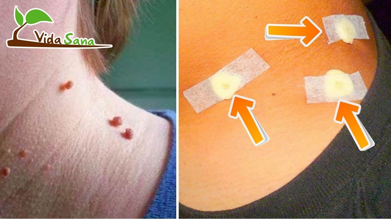 Cómo Eliminar Rápidamente Pequeñas Verrugas De La Piel Con Un Solo Ingrediente remedios naturales para la artritis