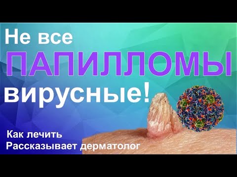 Не все папилломы вирусные/Лечение ВПЧ/Вирус папилломы человека