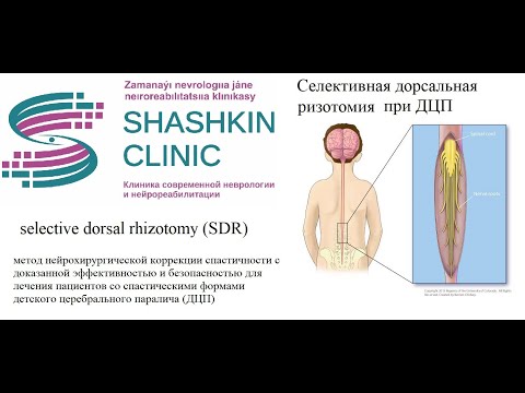 Селективная дорсальная ризотомия (СДР) при ДЦП (Детский церебральный паралич)