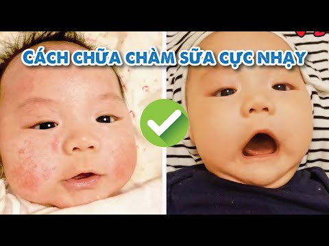 Chàm sữa ở trẻ sơ sinh và cách điều trị cực nhạy