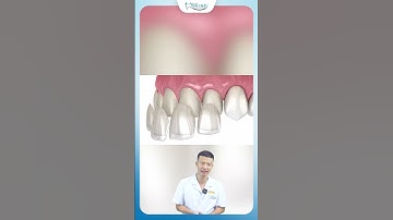 Hé Lộ Quy Trình Dán Sứ Veneer | Bác Sĩ Yên