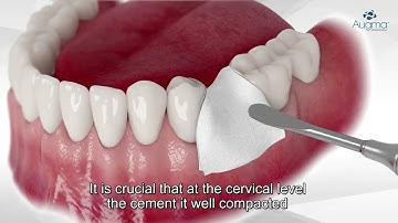 Socket Grafting without Flap Reflection - Bond Apatite® & Augma Shield™