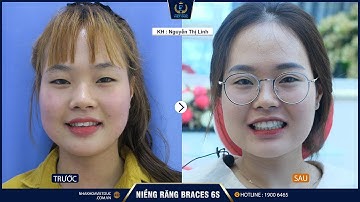 CẢM NHẬN CỦA KHÁCH HÀNG NIỀNG RĂNG TẠI NHA KHOA QUỐC TẾ VIỆT ĐỨC - NGUYỄN THỊ LINH