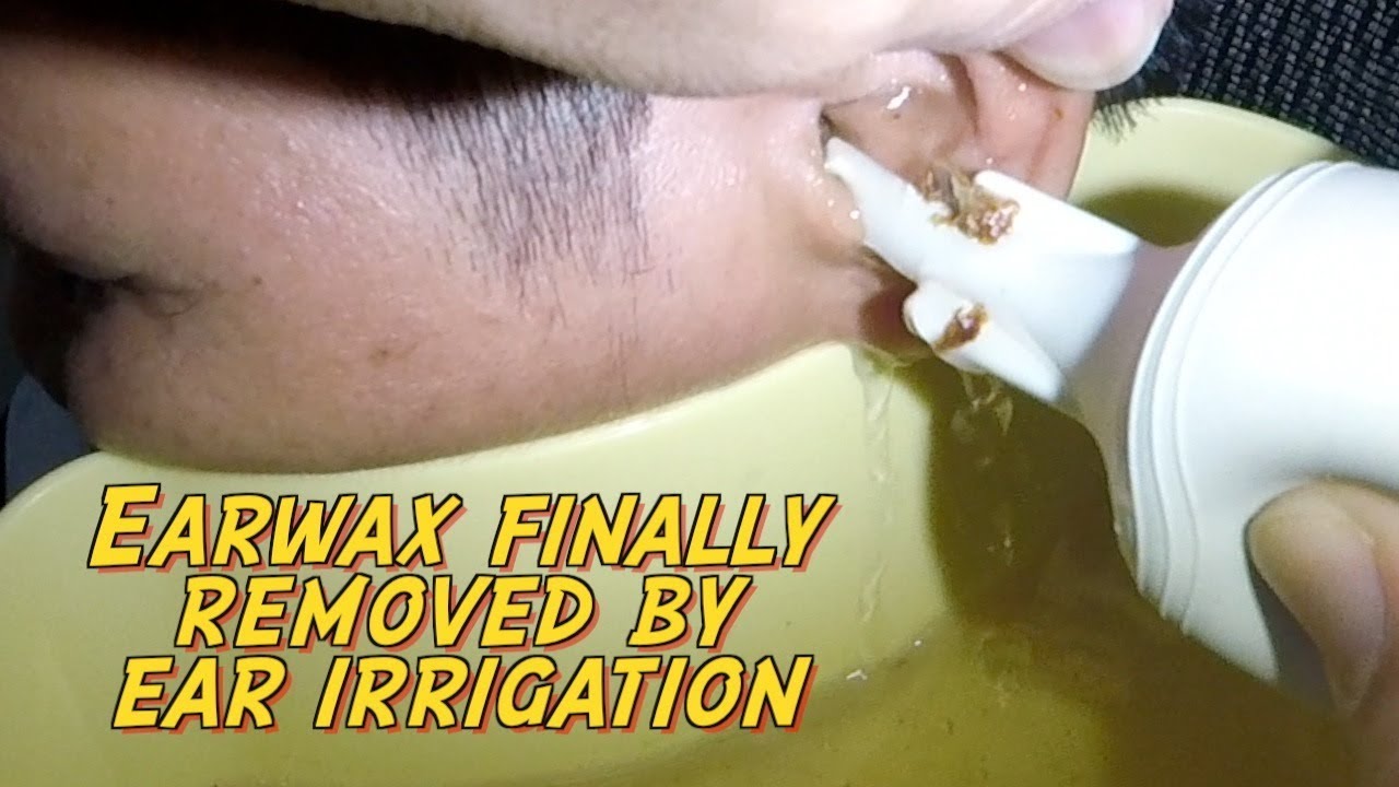 Hard Earwax Finally Removed by Ear Irrigation After 5 days of Ear wax  Softener 