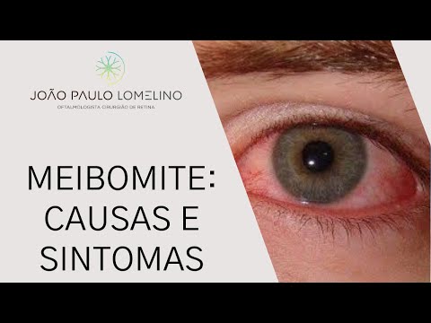 Vídeo: Meibomite: Causas, Tratamento, Diagnóstico, Prevenção E Imagens