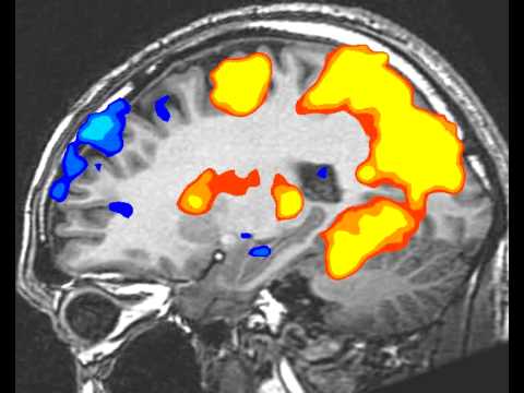 fMRI BrainScan: SideView