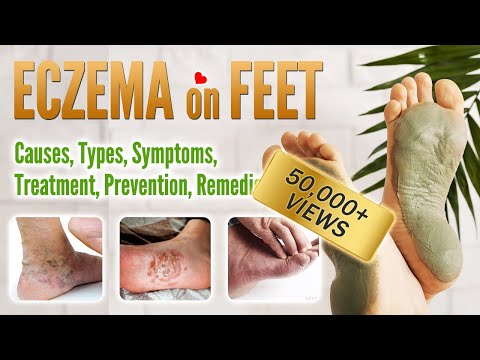 Video: Dry Eczema On Hands And Feet - Causes, Symptoms And Treatment