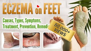 Eczema on foot Causes, Symptoms, Types, Treatment, Prevention and Home Remedies | Feet Eczema