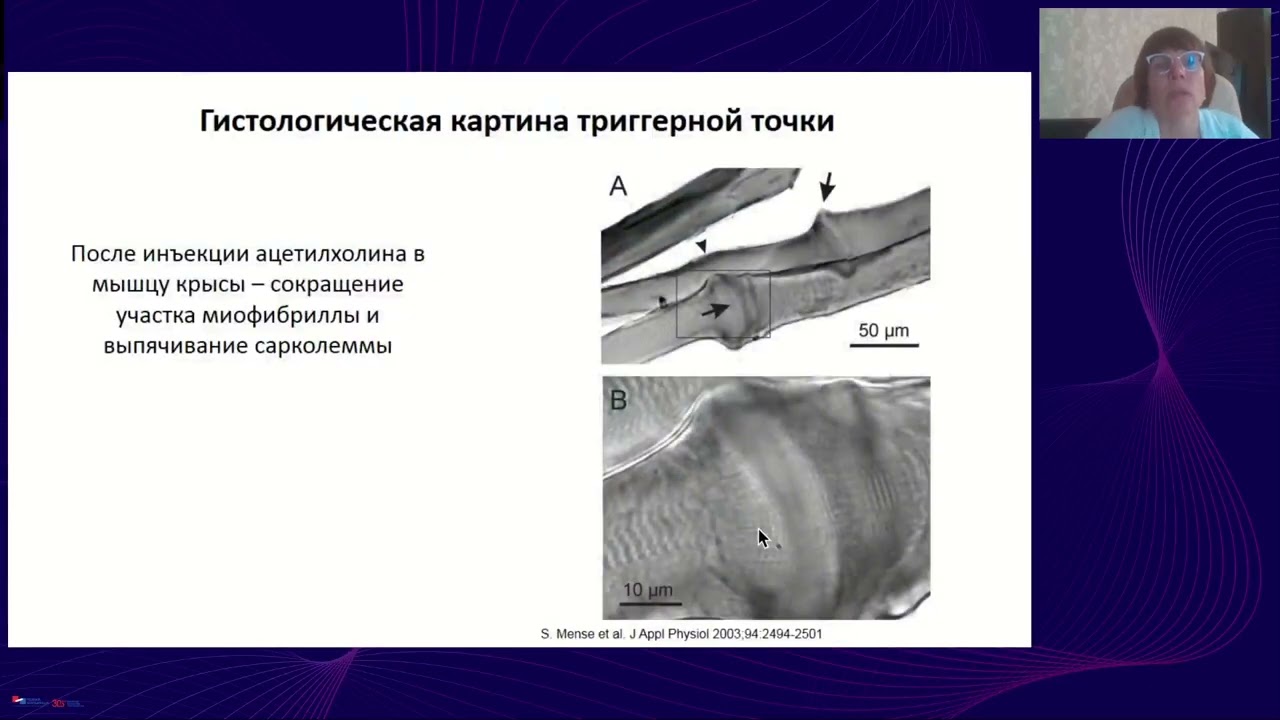 Миофасциальный синдром - частая проблема современности. Как диагностировать и как лечить?