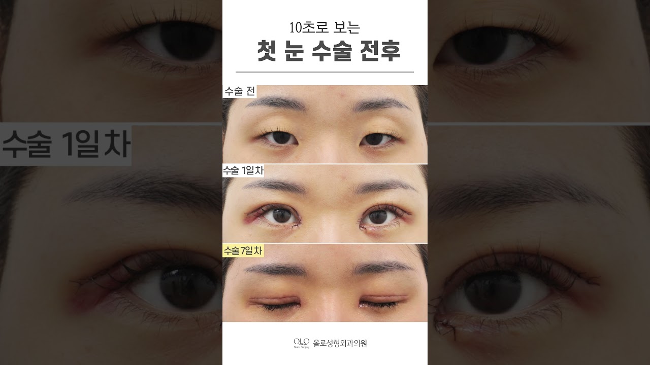 [OLLO Plastic Surgery Clinic] #Phẫu_thuật_mắt_đầu_tiên #OLLO_Plastic_Surgery mở mắt được 7 ngày #thực_tế #really #shorts