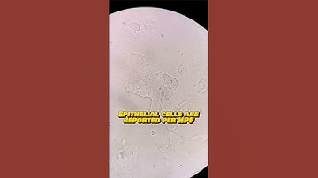 Epithelial cells in urine under the microscope #laboratory #mls #cls #mt #urinalysis #urinesediment