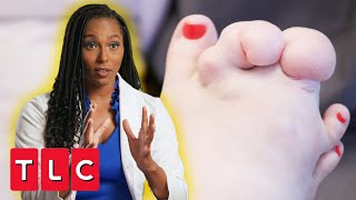 Doctor Removes 2 Lb Of Mass From Patient&#39;s Foot! | My Feet Are Killing Me