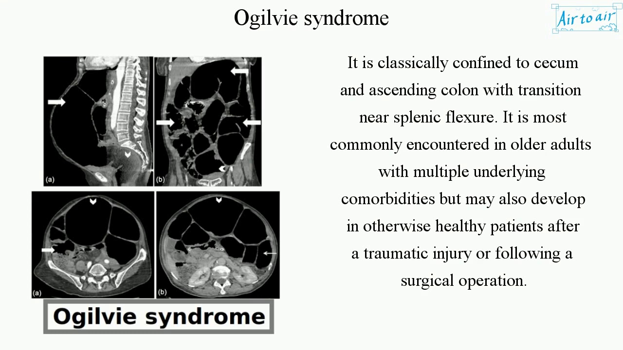 Ogilvie syndrome YouTube