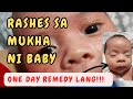 RASHES SA MUKHA ni baby| NEONATAL ACNE| REMEDY by Dr. Pedia Mom
