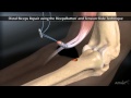 Arthrex distal biceps button tension slide technique