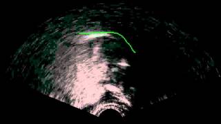 B palatal implosive half speed