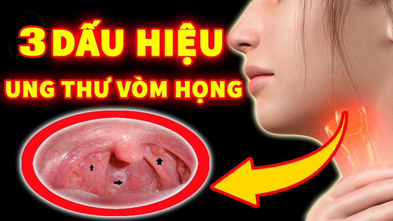 Dấu hiệu ung thư vòm họng - YouTube