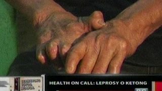 OC: Health On Call: Leprosy o Ketong