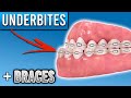 How Do Braces Fix Underbites? | Premier Orthodontics