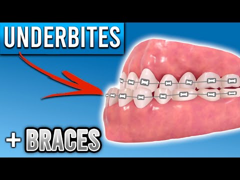 Video: Underbite: Punca, Rawatan, Pembedahan, Underbite Vs Overbite