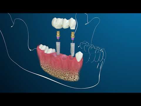 Video: Zubní Implantáty: Jsou Dobré Pro Domácí Mazlíčky
