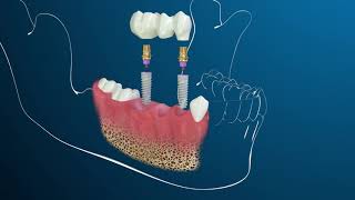 Zubní implantáty - Jednoduchá cesta, jak získat zpět Váš úsměv