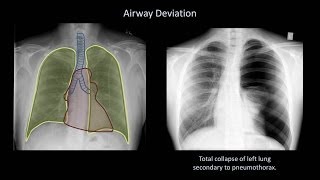 How to Interpret a Chest X-Ray (Lesson 4 - Airways, Bones, and Soft Tissues) screenshot 2