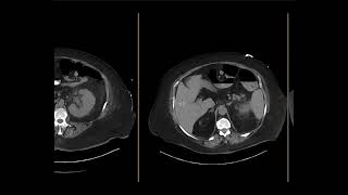 Pyelonephritis with abscess