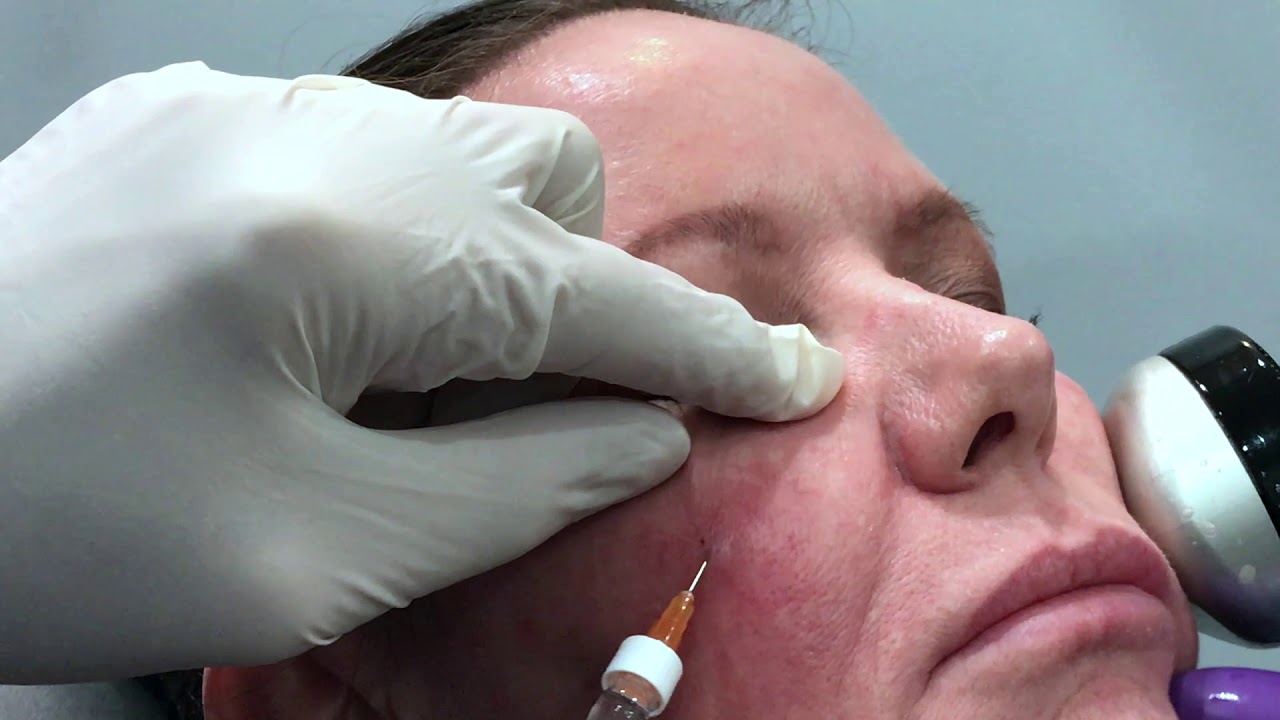 Dr. Weiner's Sandwich Technique Tear Trough Filler