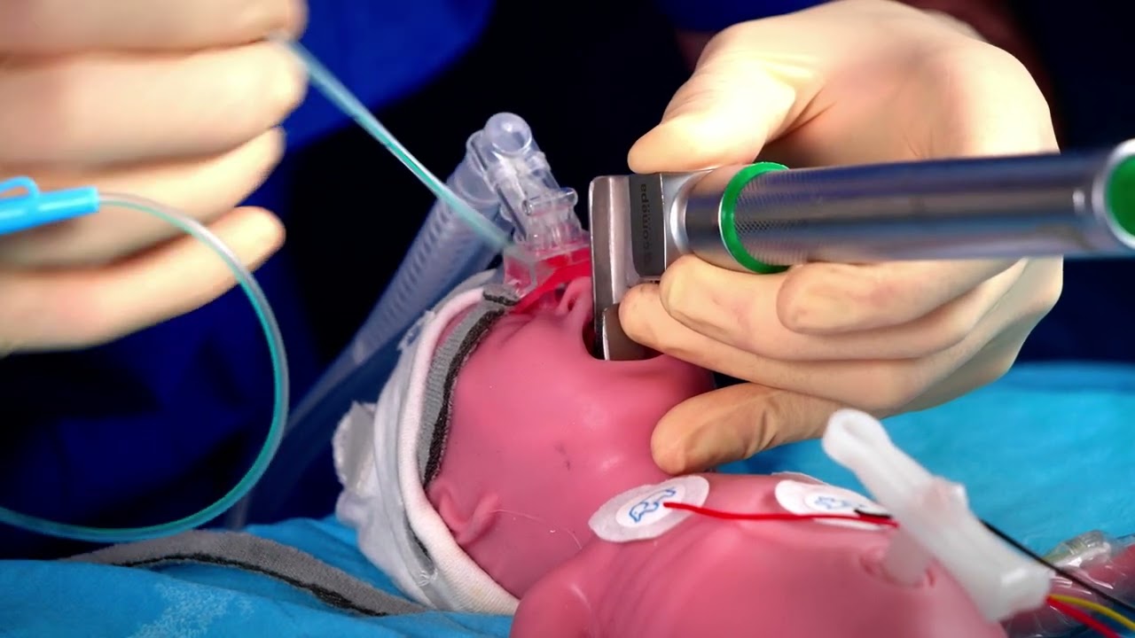 Réanimation du nouveau-né en salle de naissance : D2 Surfactant avec LARYNGOSCOPIE directe