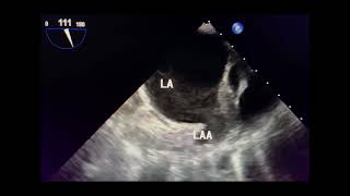 Left Atrial Appendage Sludge vs Thrombus Can Echocardiography Distinguish Them