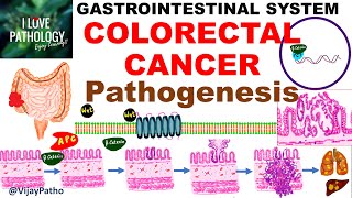 Colorectal carcinoma - Epidemiology, risk factors & Pathogenesis