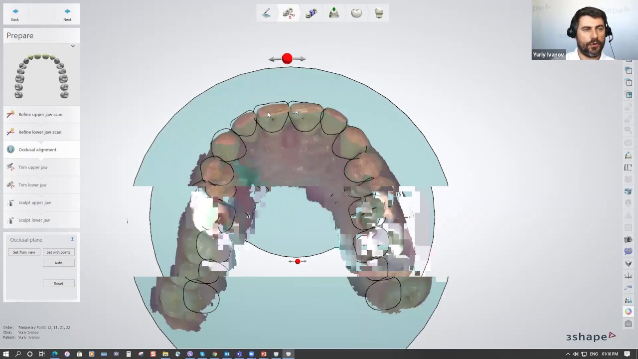 3Shape Digital Waxup Mock Up Technique YouTube