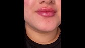 Skin Tightening, Botox And Lip Fillers La Fundamentals Explained thumbnail