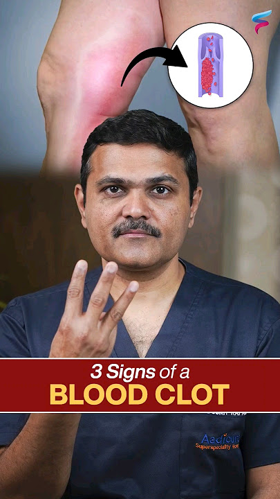 Blood Clot ALERT! Catching It Early Saves Lives #vascularsurgeon #shortsviral