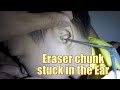 Watch How to Remove Eraser Chunk Stuck in Boy's Ear