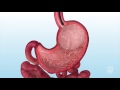 Intragastric Balloon for Weight Loss - Mayo Clinic